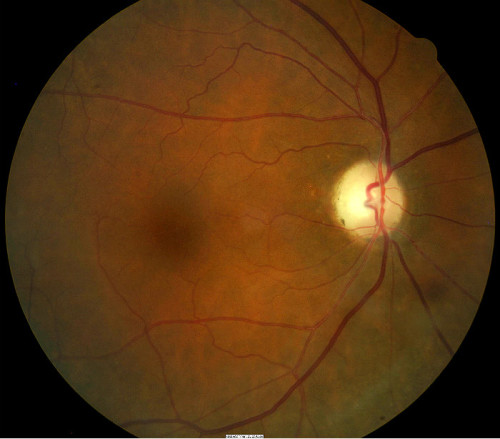 H53.52 Acquired Color Vision Deficiencies - Decision-maker Plus