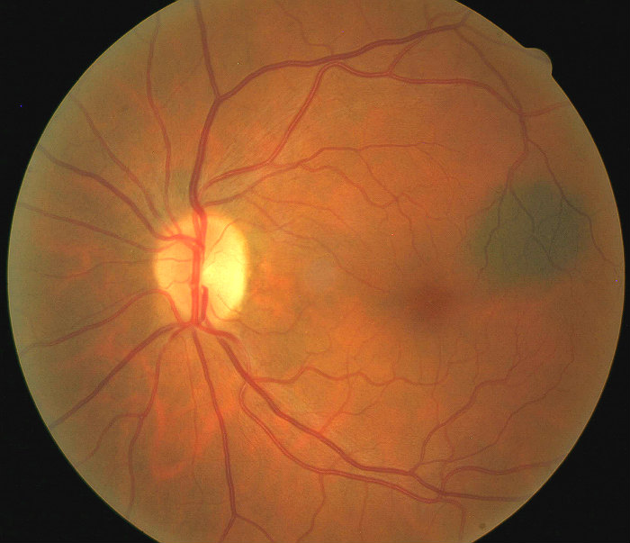 degenerative myopia bilateral