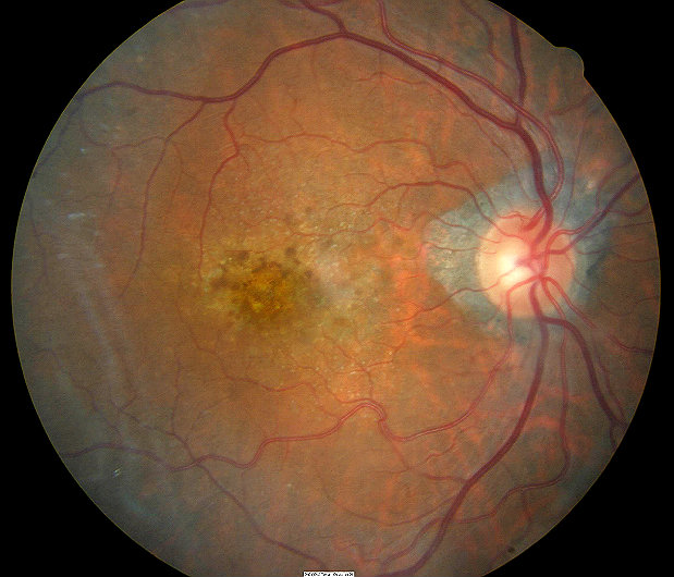 H35.31 Nonexudative Senile Macular Degeneration of Retina