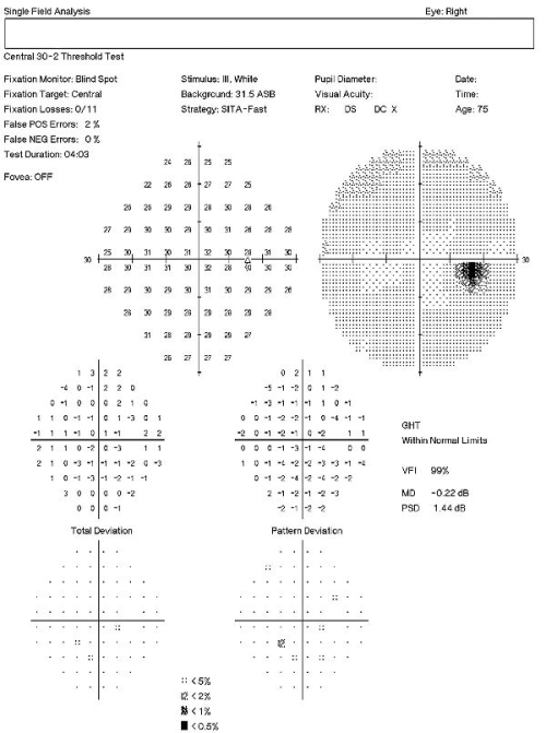 H47.211-213 Primary Optic Atrophy - Decision-Maker PLUS