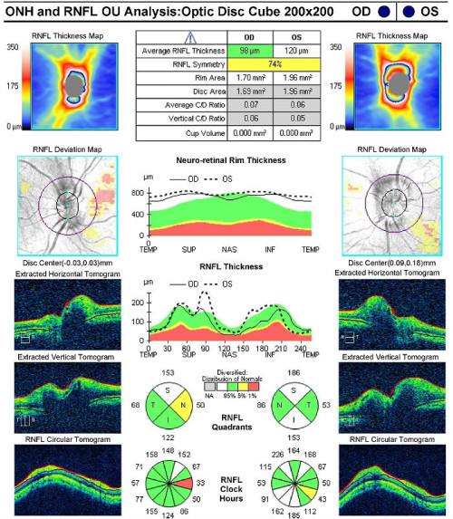 H47.11-13; H47.141-143 Papilledema - Decision-Maker PLUS