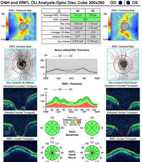 H40.011-023 Open-Angle Glaucoma Suspect, Low Risk - Decision-Maker PLUS