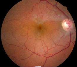 macular pucker pictures