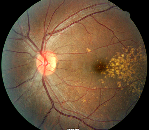 H35361 363 Drusen Degenerative Of Retina Decision Maker Plus