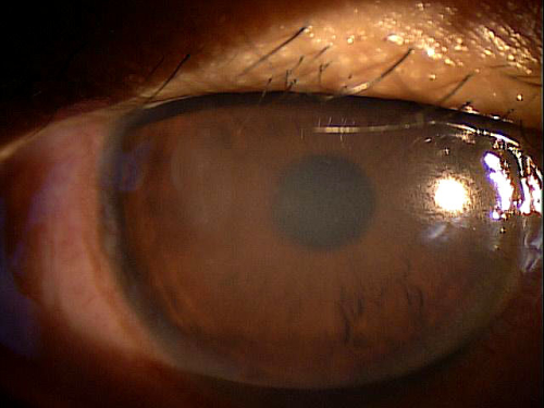 H16.011-013 Central Corneal Ulcer - Decision-maker Plus