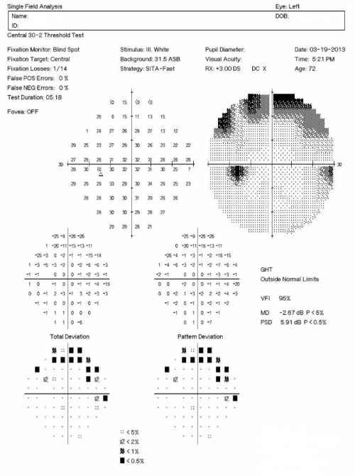 Normal-Tension Glaucoma; Abnormal Macular OCT Scan - Decision-Maker PLUS