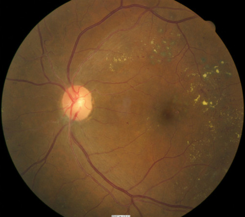 E11.321-351 Diabetic Macular Edema - Decision-Maker PLUS