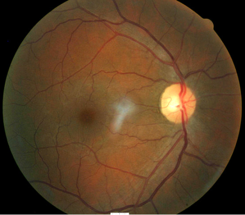 Primary Optic Atrophy - Decision-Maker PLUS