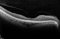 Plaquenil-Induced Toxic Maculopathy - Decision-Maker PLUS