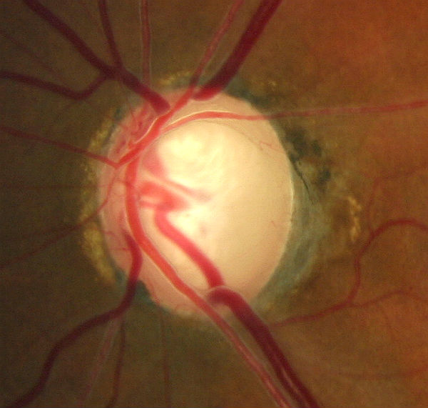 Elevated-Tension Glaucoma; Advanced Damage - Decision-Maker PLUS