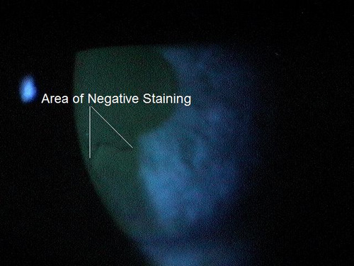 Isolated area of negative staining