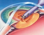 Cataract-Surgeries