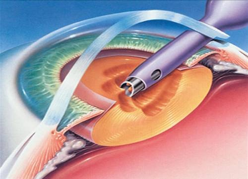 Cataract-Surgeries