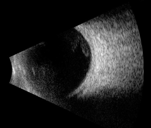 D31.31-32 Benign Neoplasm of Choroid - Decision-Maker PLUS