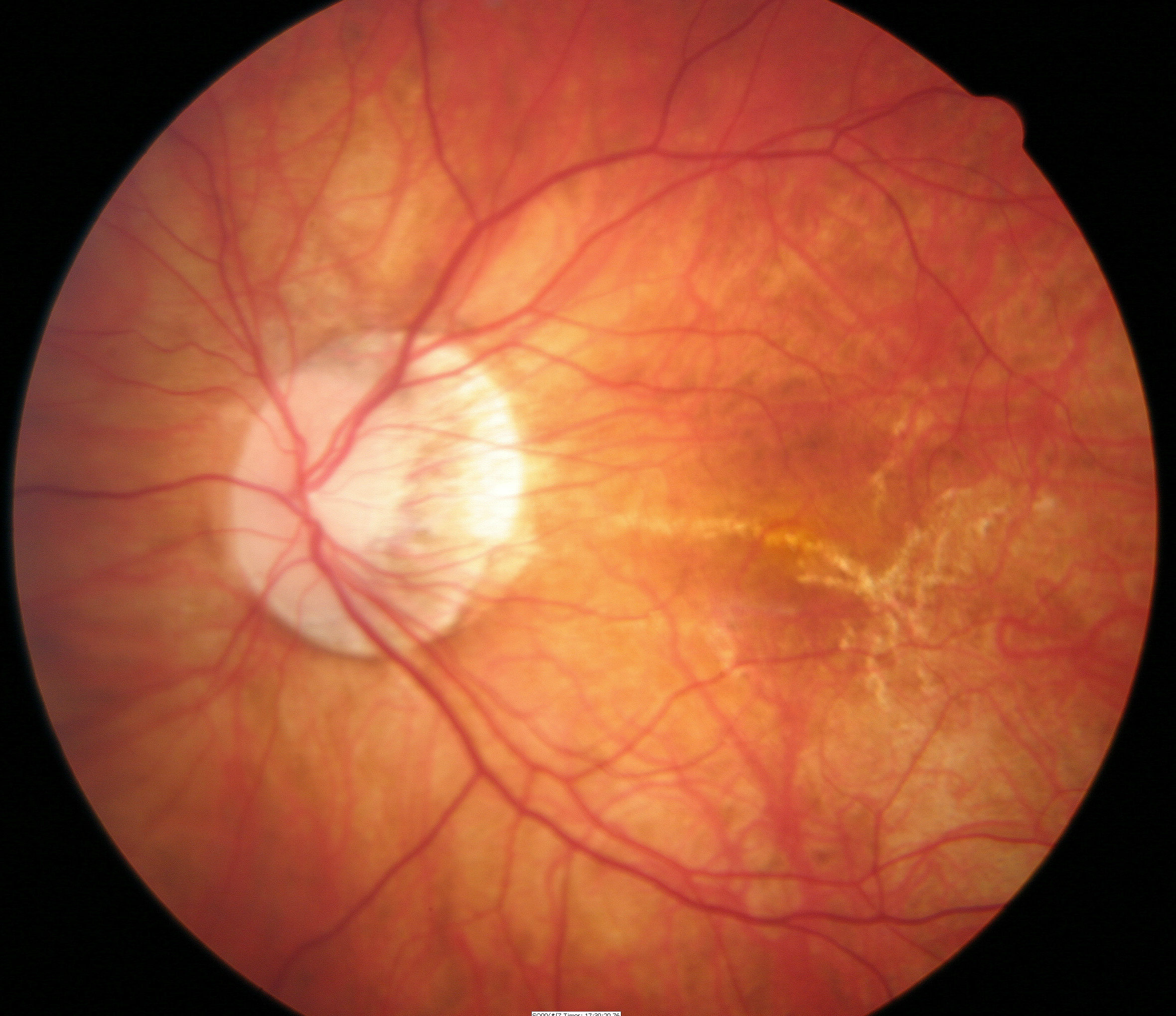 Miopia fundusului ocular