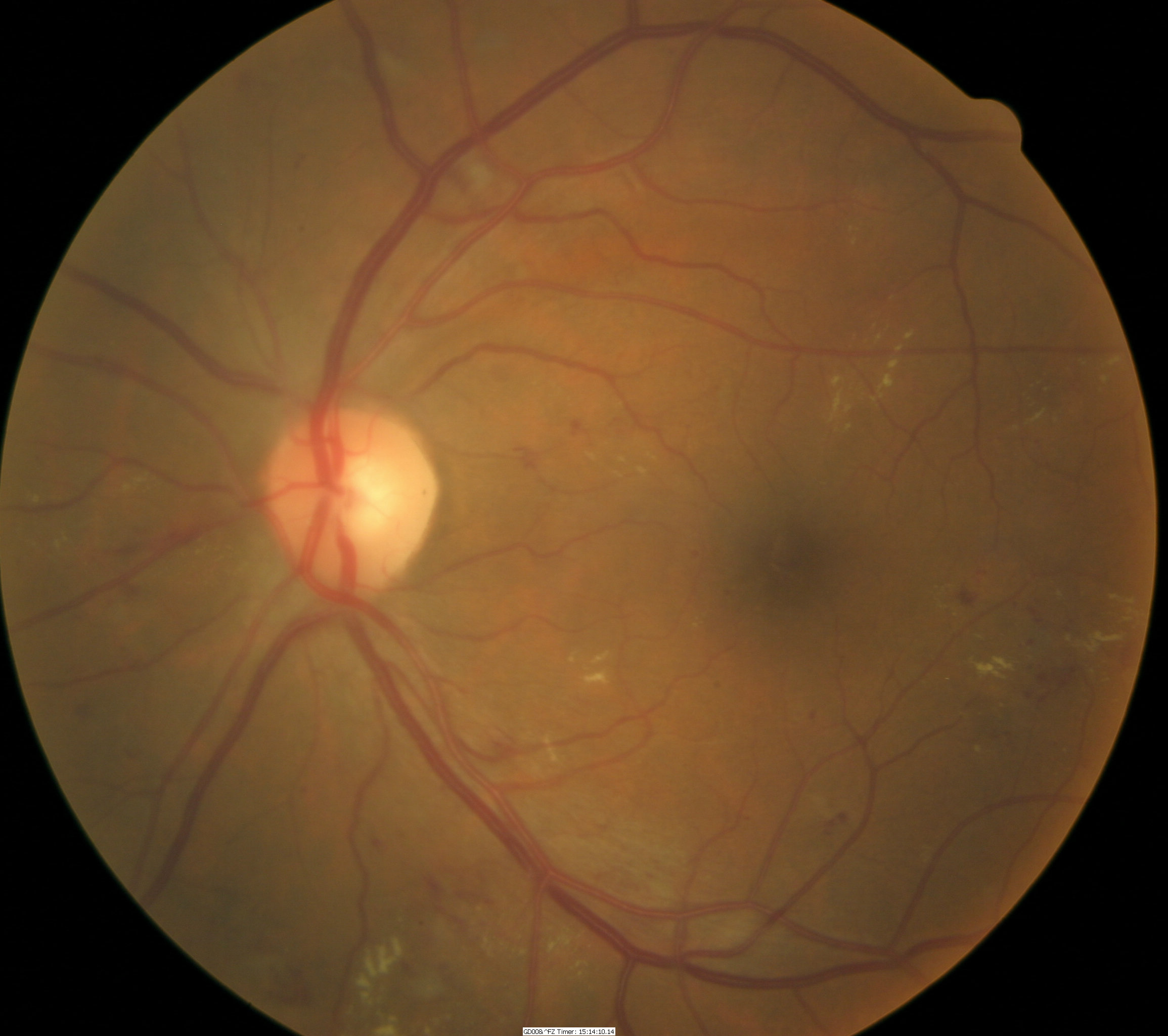 retinal edema icd 10