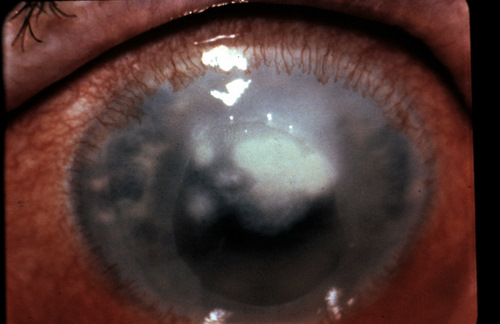 H16.011-013 Central Corneal Ulcer - Decision-Maker PLUS