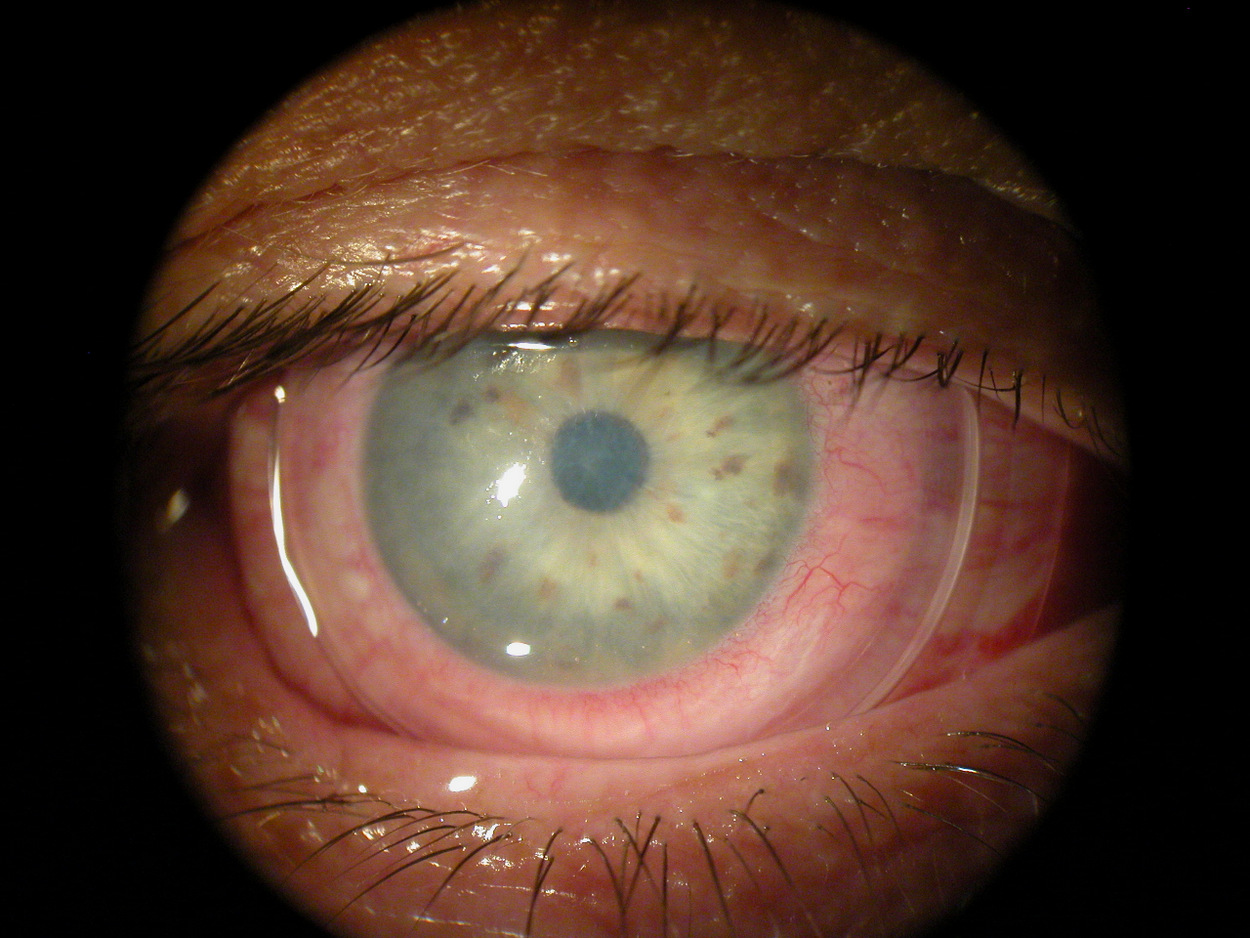 Germs Can Infiltrate the Body Via the Eyes – Omaha NE