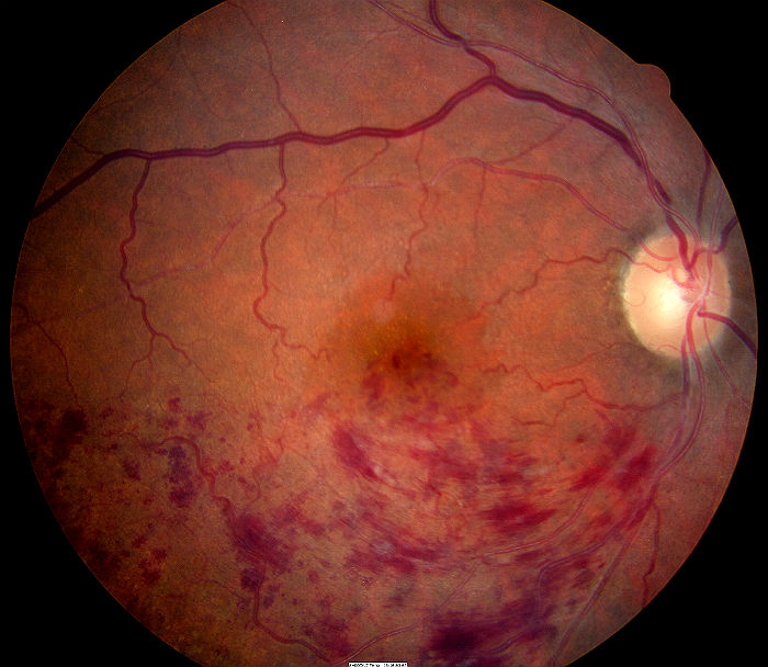 ÙØªÙØ¬Ø© Ø¨Ø­Ø« Ø§ÙØµÙØ± Ø¹Ù âªbranch retinal vein occlusionâ¬â