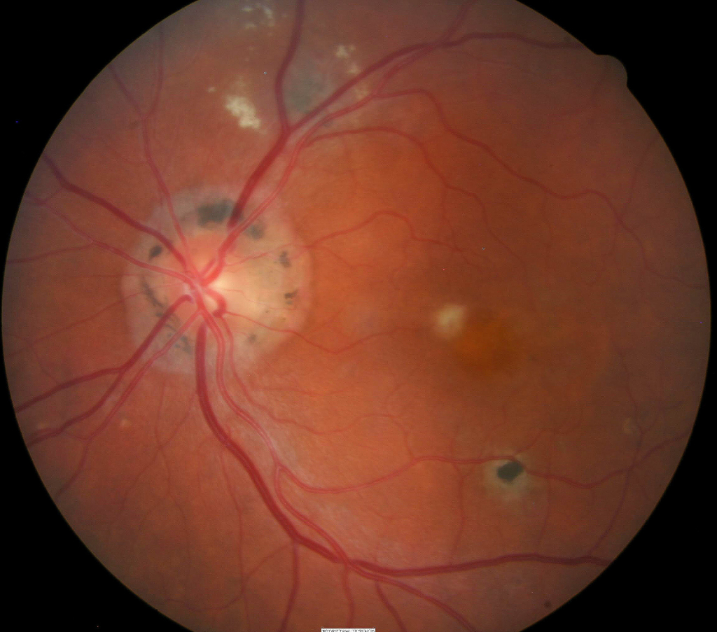lattice hole in retina