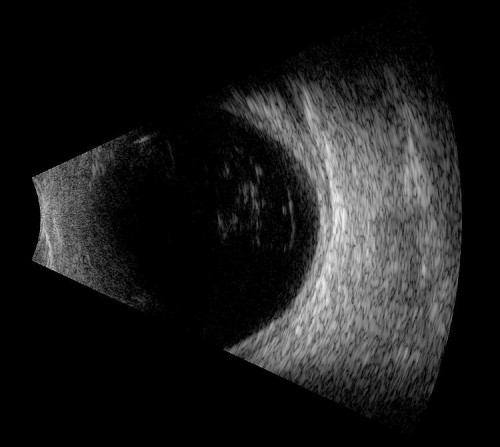 H20.011-013 Primary Iridocyclitis - Decision-Maker PLUS