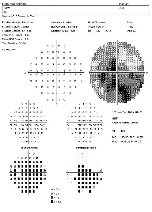 H53.413 Visual Field Defect - Decision-Maker PLUS