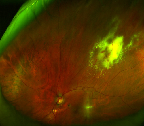 H35.031-033 Hypertensive Retinopathy - Decision-Maker PLUS