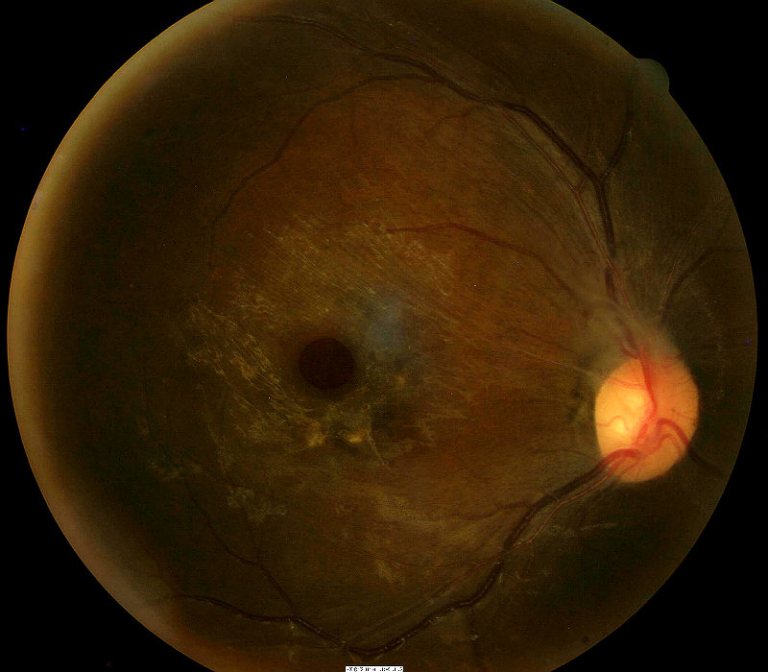 computer burn hole in retina
