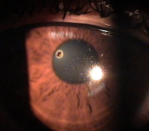 T15.01XA-02XA Corneal Foreign Body - Decision-Maker PLUS